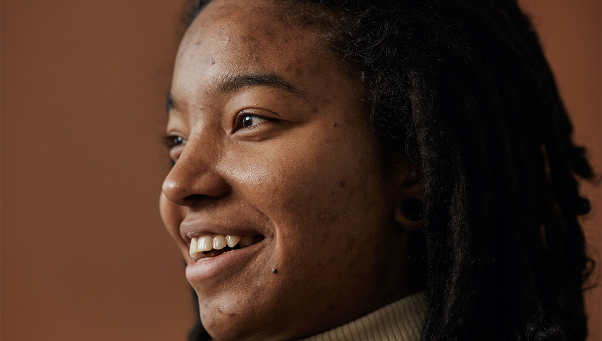 Acne Scars FAQs: “Will My Acne Scars Ever Go Away?”